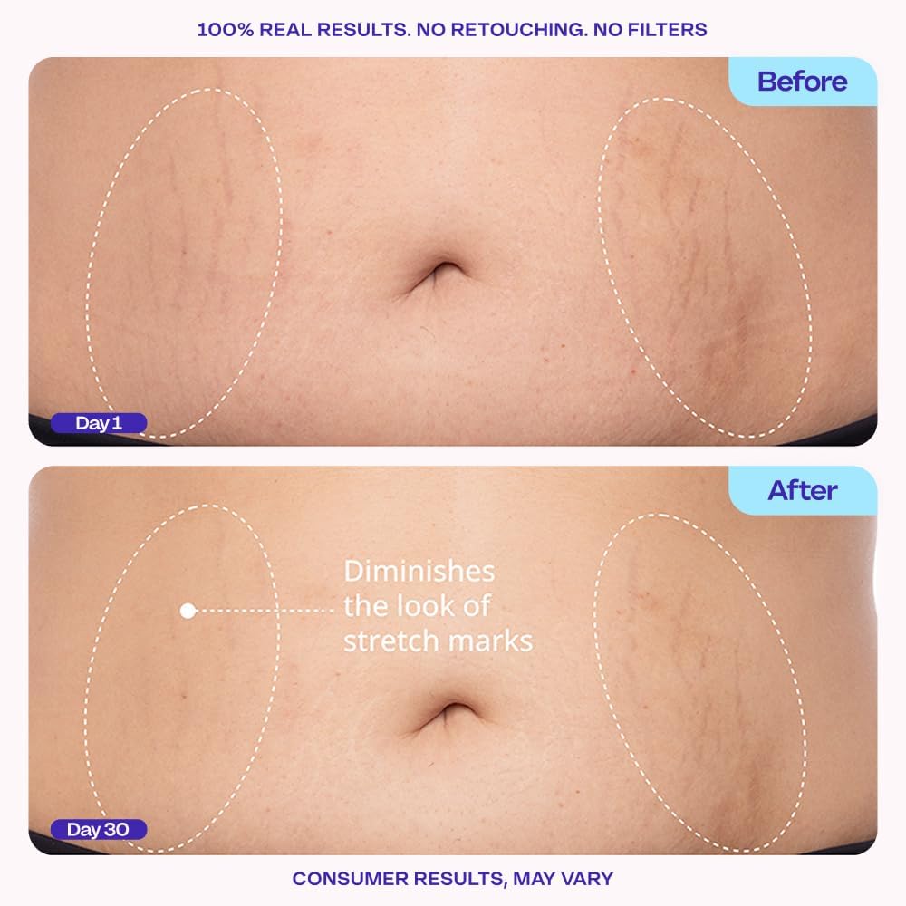 Belly Firming Cream - 6% MicroTight4™ Complex For Smoother, Firmer-Looking Skin